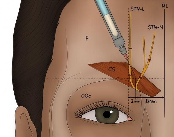 Botox and the Treatment of Chronic Migraines: Current Efficacy and Future Directions